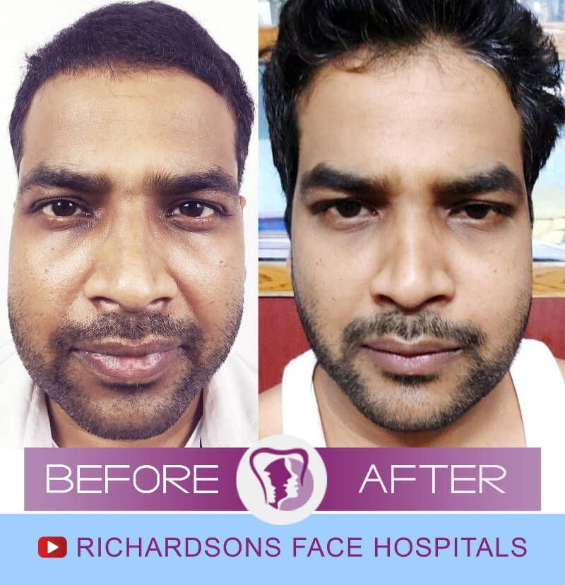 Prateek Jaw Surgery