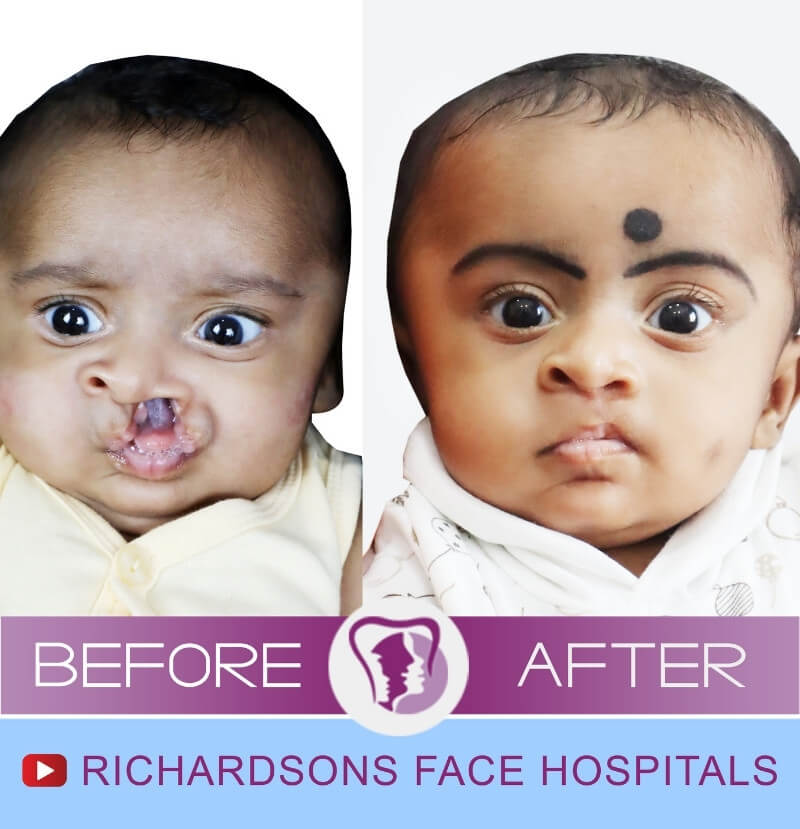 Aadhiyanath Cleft Lip Palate Surgery