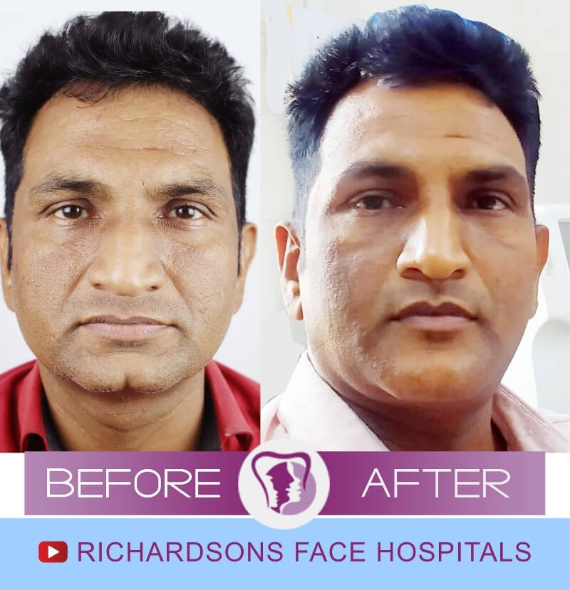 Ashok Genioplasty Surgery
