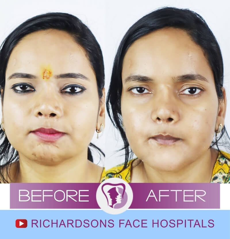 Deji Kumari Jaw Surgery