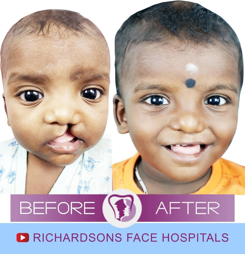 Sharvesh Cleft Lip Palate Surgery
