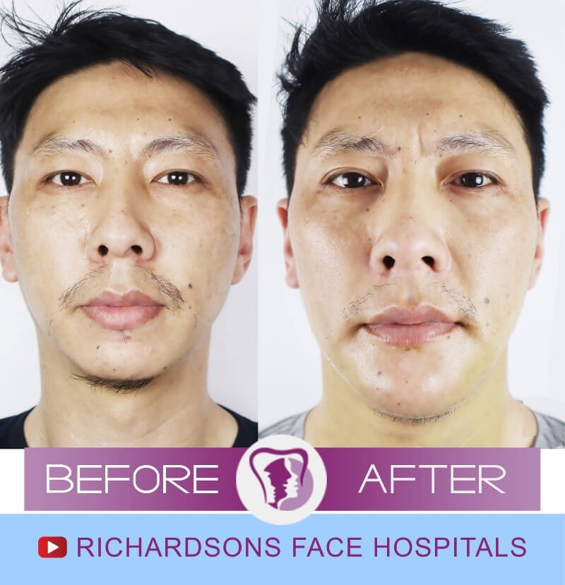 Wangchuk Jaw Surgery