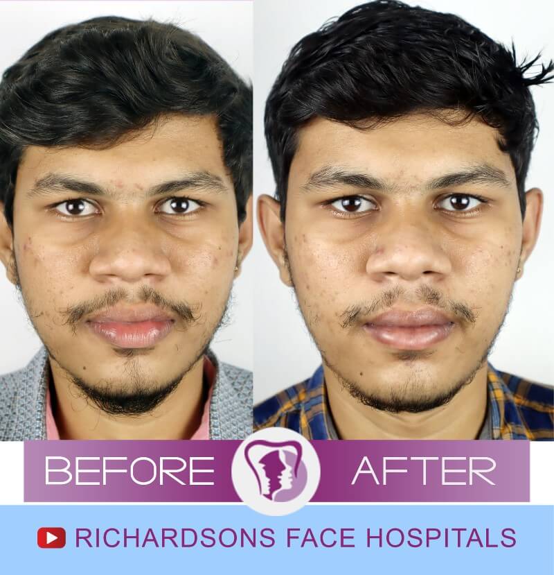 Lip Revision Richardson's Plastic Surgery Hospitals