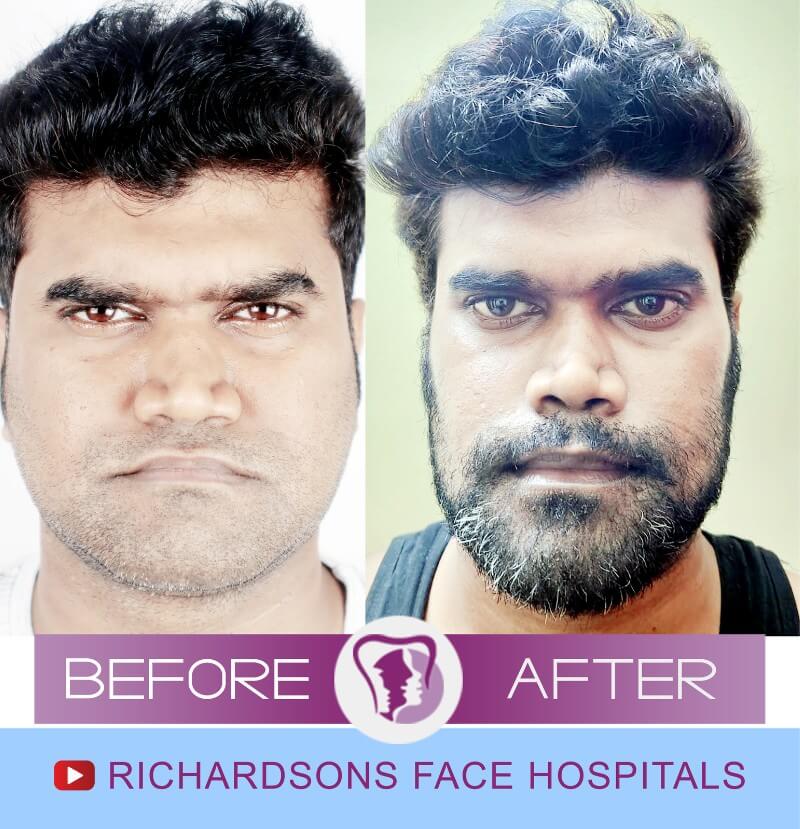 Jaw Surgery - Richardson's Plastic Surgery Hospitals
